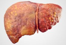 Fatty liver disorder contributes to cardiovascular disease and vice versa Fatty liver