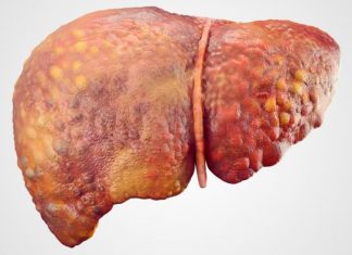 Fatty liver disorder contributes to cardiovascular disease and vice versa Fatty liver