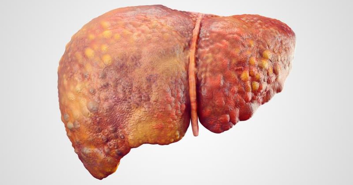what is a fatty liver