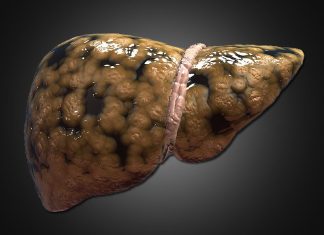 Obesity affects liver fitness in youngsters as younger as eight years antique fatty_liver