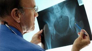 osteoporosis-treatment-heading